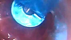 Endoscope POV: Test Tube Cock Urethral Insertion